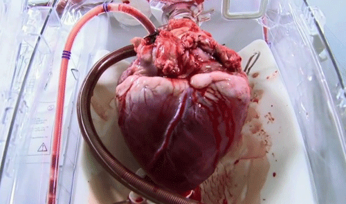 Serce tuż przed przeszczepem