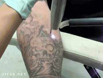 Błyskawiczne usuwanie tatuażu