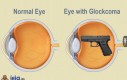 Zdrowe oko vs Oko z jaskrą
