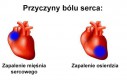 Przyczyny bólu serca