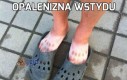 Opalenizna wstydu